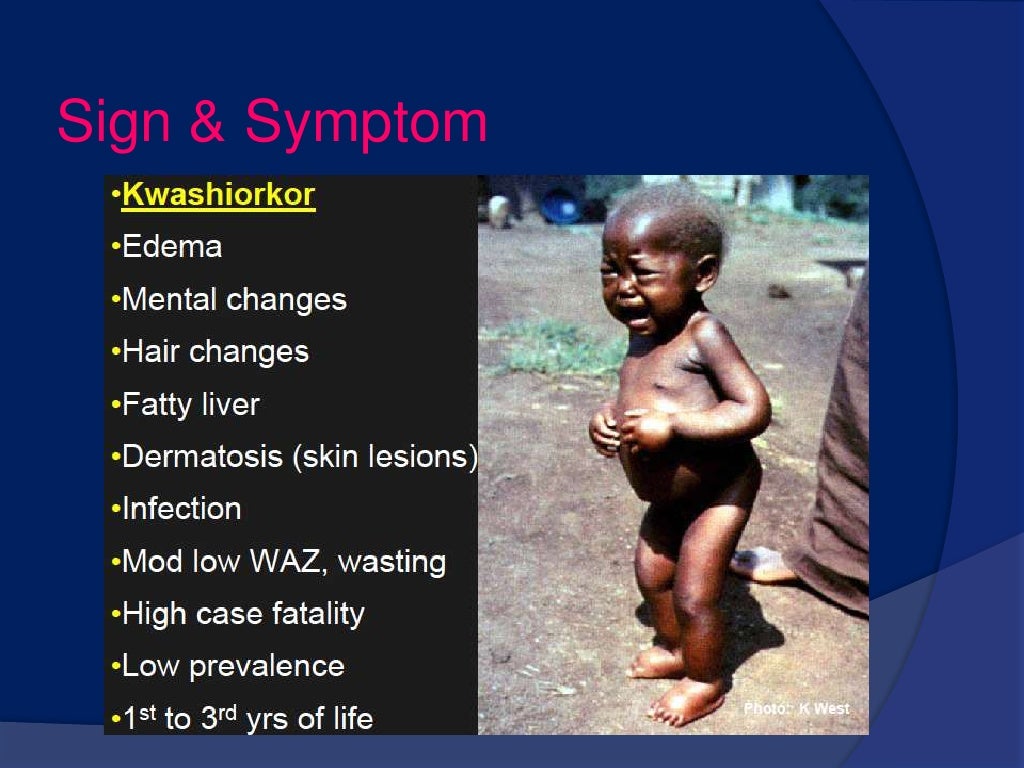 case study of kwashiorkor