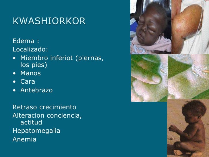 Que Es Kwashiorkor