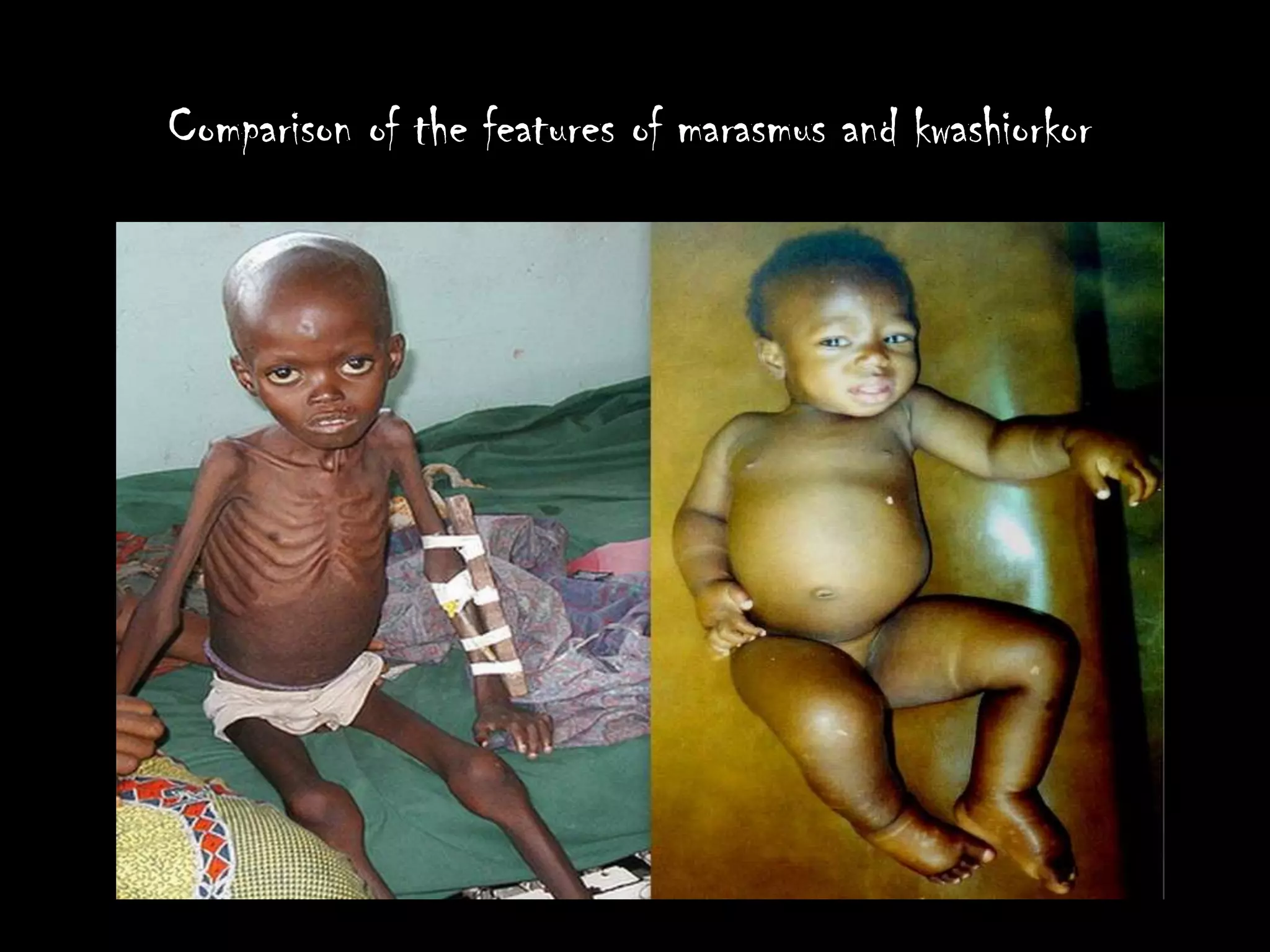Kwashiorkor PPTX Kwashiorkor PPTX