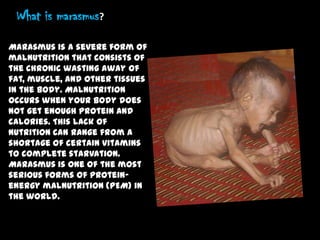 What is marasmus?
Marasmus is a severe form of
malnutrition that consists of
the chronic wasting away of
fat, muscle, and other tissues
in the body. Malnutrition
occurs when your body does
not get enough protein and
calories. This lack of
nutrition can range from a
shortage of certain vitamins
to complete starvation.
Marasmus is one of the most
serious forms of protein-
energy malnutrition (PEM) in
the world.
 