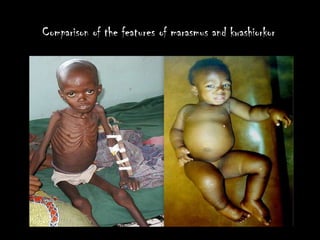 Comparison of the features of marasmus and kwashiorkor
 