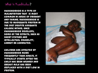 What is Kwashiorkor?
Kwashiorkor is a type of
malnutrition that is most
common in areas of drought
and famine. Kwashiorkor is
due to inadequate protein in
the diet despite adequate
caloric intake. Once
kwashiorkor develops,
some of the effects, such as
short stature and
intellectual disability,
cannot be corrected.
Children are affected by
kwashiorkor more
frequently than adults. It
typically starts after the
child has been weaned and
breast milk has been
replaced with a diet low in
protein.
 