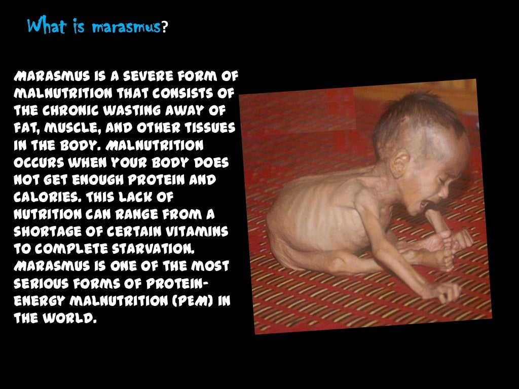 Kwashiorkor