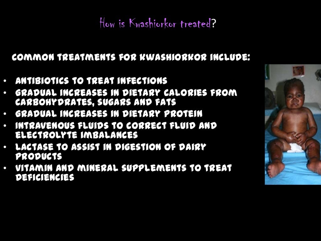 Kwashiorkor