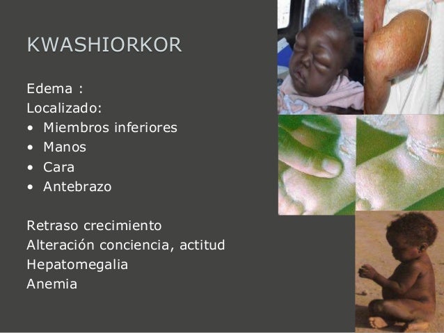 Kwashiorkor Skin Rashes