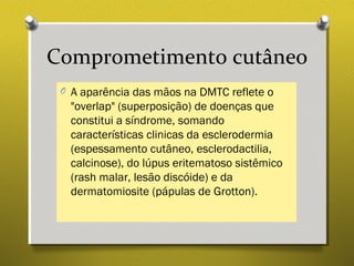 Comprometimento cutâneo
O A aparência das mãos na DMTC reflete o
"overlap" (superposição) de doenças que
constitui a síndrome, somando
características clinicas da esclerodermia
(espessamento cutâneo, esclerodactilia,
calcinose), do lúpus eritematoso sistêmico
(rash malar, lesão discóide) e da
dermatomiosite (pápulas de Grotton).
 
