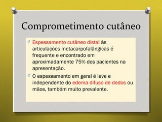 Comprometimento cutâneo
O Espessamento cutâneo distal às
articulações metacarpofalângicas é
frequente e encontrado em
aproximadamente 75% dos pacientes na
apresentação.
O O espessamento em geral é leve e
independente do edema difuso de dedos ou
mãos, também muito prevalente.
 
