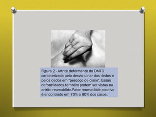 Figura 2 - Artrite deformante da DMTC
caracterizada pelo desvio ulnar dos dedos e
pelos dedos em "pescoço de cisne". Essas
deformidades também podem ser vistas na
artrite reumatóide.Fator reumatóide positivo
é encontrado em 70% a 80% dos casos.
 