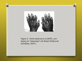 Figura 3 - Artrite destrutiva na DMTC, com
dedos em "telescópio" (de Robert M.Bennet,
UpToDate, 2007).
 