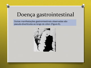 Doença gastrointestinal
Outras manifestações gastrointestinais observadas são
pseudo-divertículos ao longo do cólon (Figura 6).
 