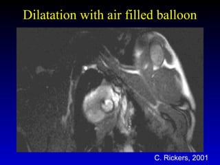 Dilatation with air filled balloonDilatation with air filled balloon
C. Rickers, 2001
 