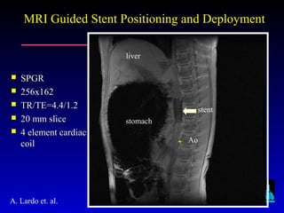 Johns Hopkins University
MRI Guided Stent Positioning and DeploymentMRI Guided Stent Positioning and Deployment
stent
liver
stomach
Ao
 SPGRSPGR
 256x162256x162
 TR/TE=4.4/1.2TR/TE=4.4/1.2
 20 mm slice20 mm slice
 4 element cardiac4 element cardiac
coilcoil
A. Lardo et. al.
 