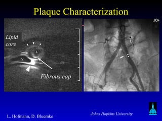 Johns Hopkins University
L. Hofmann, D. Bluemke
Fibrous cap
Lipid
core
Plaque CharacterizationPlaque Characterization
 