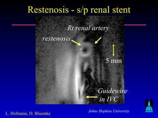 Johns Hopkins University
Restenosis - s/p renal stentRestenosis - s/p renal stent
5 mm
L. Hofmann, D. Bluemke
Rt renal artery
Guidewire
in IVC
restenosis
 