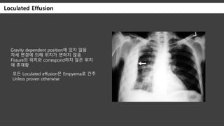 Pleural effusion | PPTX