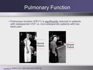 Pulmonary Function Pulmonary function (FEV1) is  significantly  reduced in patients with osteoporotic VCF  vs.  non-osteoporotic patients with low back pain.   Normal Posture Stooped  Posture Schlaich C, et al. (1998) Osteoporosis Int’l 8:261-267 