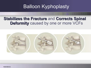Balloon Kyphoplasty Stabilizes the Fracture  and  Corrects Spinal Deformity   caused by one or more VCFs 