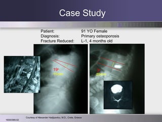 Case Study 19 o 3 o 15mm 28mm Patient: 91 YO Female Diagnosis: Primary osteoporosis Fracture Reduced: L-1, 4 months old Courtesy of Alexander Hadjipavlou, M.D., Crete, Greece 