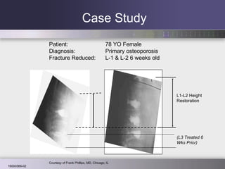 Case Study Patient: 78 YO Female Diagnosis: Primary osteoporosis Fracture Reduced: L-1 & L-2 6 weeks old Courtesy of Frank Phillips, MD, Chicago, IL (L3 Treated 6 Wks Prior) L1-L2 Height Restoration 