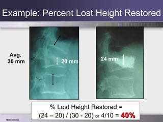 Example: Percent Lost Height Restored % Lost Height Restored =  (24 – 20) / (30 - 20)  or  4/10 =  40% 20 mm 24 mm Avg.  30 mm 