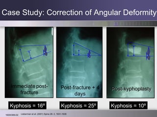 Case Study: Correction of Angular Deformity Kyphosis = 25 º Kyphosis = 10 º Kyphosis = 16 º Immediate   post- fracture Post-kyphoplasty Post-fracture + 4 days Lieberman et al. (2001)  Spine 26: 2, 1631-1638 