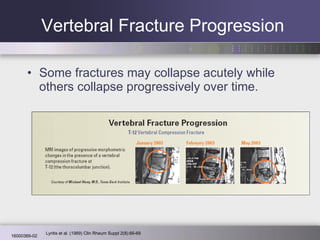 Vertebral Fracture Progression Some fractures may collapse acutely while others collapse progressively over time. Lyritis et al. (1989) Clin Rheum Suppl 2(8):66-69 