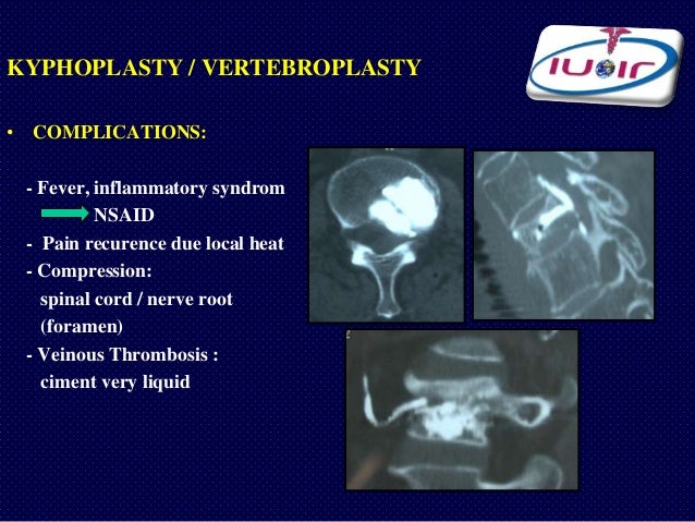 What are the complications related to kyphoplasty?