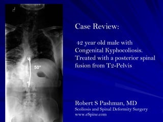 Case Review:
       42 year old male with
      Congenital Kyphocoliosis.
      Treated with a posterior spinal
50°   fusion from T2-Pelvis




      Robert S Pashman, MD
      Scoliosis and Spinal Deformity Surgery
      www.eSpine.com
 