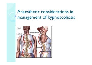 1
·
0 ~
Anaesthetic considerations in
management of kyphoscoliosis
 