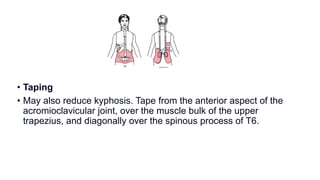 • Taping
• May also reduce kyphosis. Tape from the anterior aspect of the
acromioclavicular joint, over the muscle bulk of the upper
trapezius, and diagonally over the spinous process of T6.
 