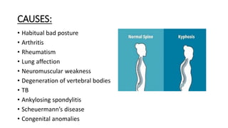 CAUSES:
• Habitual bad posture
• Arthritis
• Rheumatism
• Lung affection
• Neuromuscular weakness
• Degeneration of vertebral bodies
• TB
• Ankylosing spondylitis
• Scheuermann’s disease
• Congenital anomalies
 