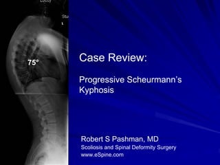 75°
      Case Review:
      Progressive Scheurmann’s
      Kyphosis




      Robert S Pashman, MD
      Scoliosis and Spinal Deformity Surgery
      www.eSpine.com
 