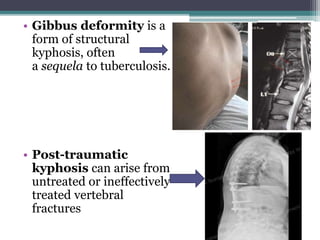 • Gibbus deformity is a
form of structural
kyphosis, often
a sequela to tuberculosis.
• Post-traumatic
kyphosis can arise from
untreated or ineffectively
treated vertebral
fractures
 