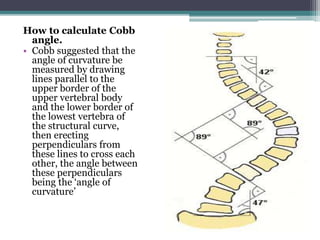 How to calculate Cobb
angle.
• Cobb suggested that the
angle of curvature be
measured by drawing
lines parallel to the
upper border of the
upper vertebral body
and the lower border of
the lowest vertebra of
the structural curve,
then erecting
perpendiculars from
these lines to cross each
other, the angle between
these perpendiculars
being the ‘angle of
curvature’
 