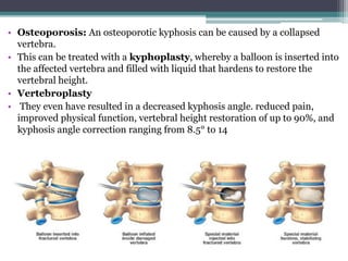 • Osteoporosis: An osteoporotic kyphosis can be caused by a collapsed
vertebra.
• This can be treated with a kyphoplasty, whereby a balloon is inserted into
the affected vertebra and filled with liquid that hardens to restore the
vertebral height.
• Vertebroplasty
• They even have resulted in a decreased kyphosis angle. reduced pain,
improved physical function, vertebral height restoration of up to 90%, and
kyphosis angle correction ranging from 8.5° to 14
 
