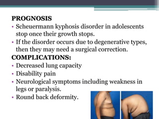PROGNOSIS
• Scheuermann kyphosis disorder in adolescents
stop once their growth stops.
• If the disorder occurs due to degenerative types,
then they may need a surgical correction.
COMPLICATIONS:
• Decreased lung capacity
• Disability pain
• Neurological symptoms including weakness in
legs or paralysis.
• Round back deformity.
 