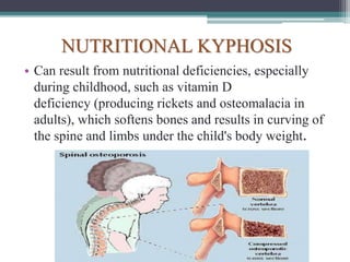 NUTRITIONAL KYPHOSIS
• Can result from nutritional deficiencies, especially
during childhood, such as vitamin D
deficiency (producing rickets and osteomalacia in
adults), which softens bones and results in curving of
the spine and limbs under the child's body weight.
 