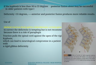 KYPHOSIS.pptx KYPHOSIS DEFORMITY OF THE SPINE | PPTX
