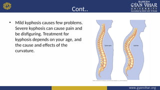 Comprehensive Overview of Kyphosis: Causes, Diagnosis, and Treatment | PPTX