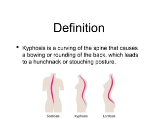Definition
• Kyphosis is a curving of the spine that causes
a bowing or rounding of the back, which leads
to a hunchnack or stouching posture.
 