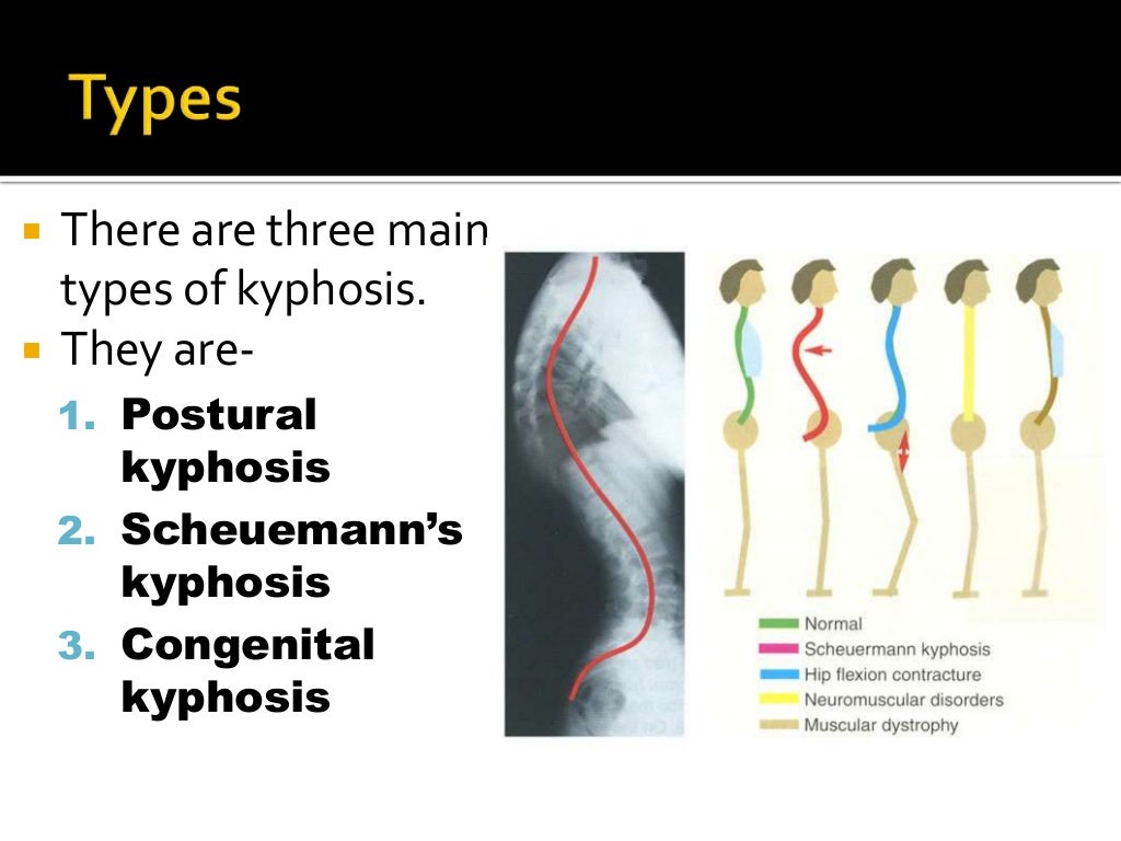 Kyphosis lordosis
