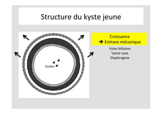 Structure	du	kyste	jeune	
Scolex	
Croissance	
è	Entrave	mécanique	
Voies	biliaires	
Veine	cave	
Diaphragme	
 