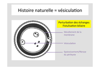 Histoire	naturelle	=	vésiculaKon	
	
	
Décollement	de	la	
membrane	
	
	
VésiculaKon	
	
	
Epaississement/ﬁbrose	
du	périkyste	
	
PerturbaKon	des	échanges	
FistulisaKon	biliaire	
 