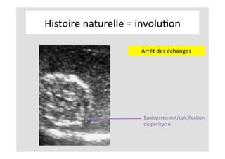 Histoire	naturelle	=	involuKon	
	
	
	
	
	
	
	
	
	
Epaississement/calciﬁcaKon	
du	périkyste	
	
Arrêt	des	échanges	
 