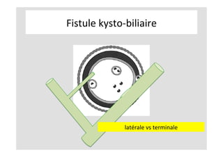 Fistule	kysto-biliaire	
latérale	vs	terminale	
 