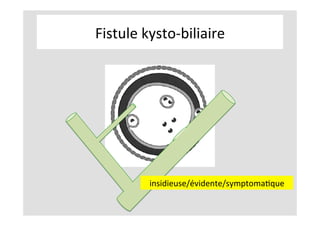 Fistule	kysto-biliaire	
insidieuse/évidente/symptomaKque	
 