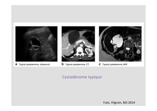 Fuks,	Vilgrain,	BJS	2014	
Cystadénome	typique	
 