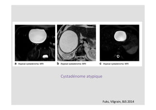 Fuks,	Vilgrain,	BJS	2014	
Cystadénome	atypique	
 