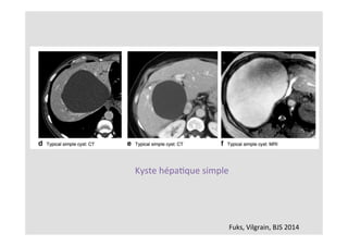 Fuks,	Vilgrain,	BJS	2014	
Kyste	hépaKque	simple	
 