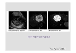 Fuks,	Vilgrain,	BJS	2014	
Kyste	hépaKque	atypique	
 